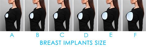 Breast augmentation